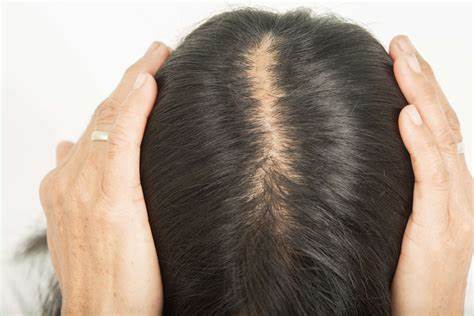 Hair Loss Treatment Image